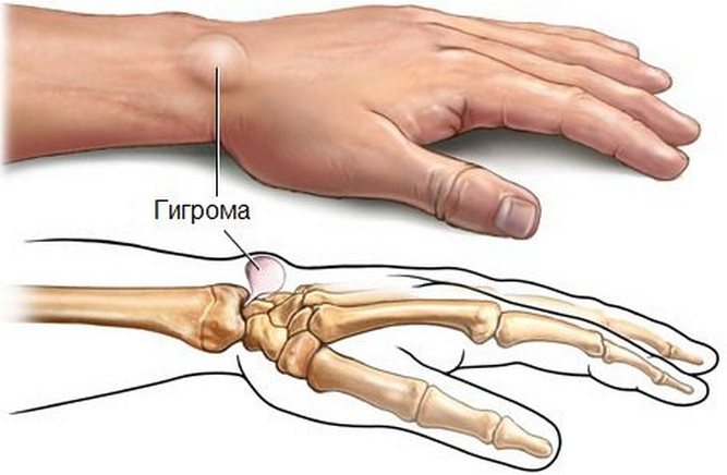 keskmise sorme reumatoidartriit sorme liigesepoletik parast vigastust