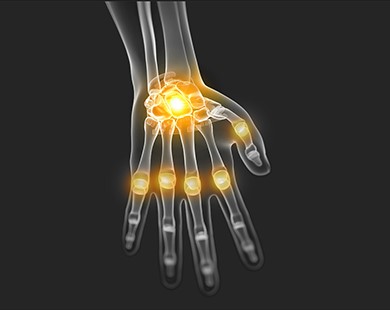 alumis liigese haigused artriidi ennetamine sormede kohta
