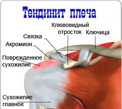 meniscuse ja artroosi ravi