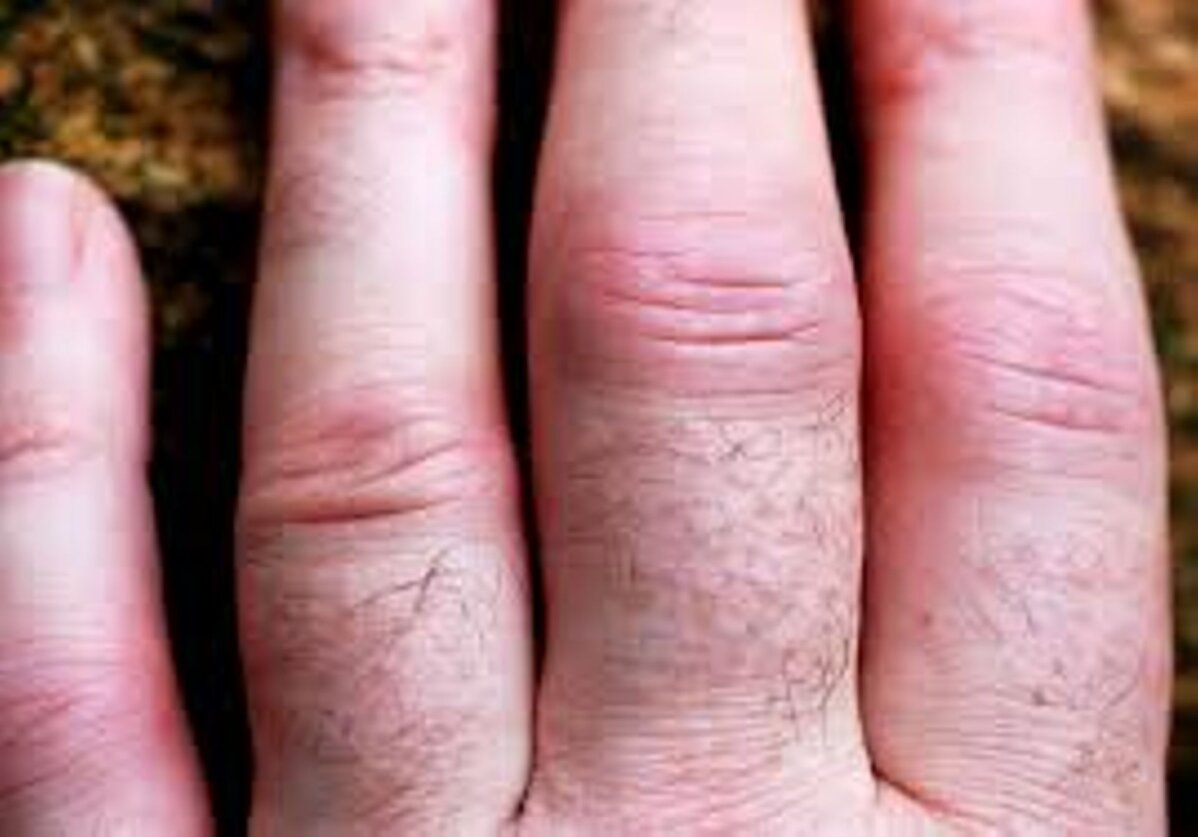 sormede jalgade artriit mis on jala artriit