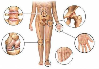 artroosi liigeste arendamine sustav sustavnaya turse