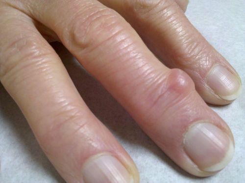 sormede ravi liigeste artroos