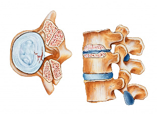 osteokondroosi kaela valu artriidi artriidi inimeste meetodid nende raviks