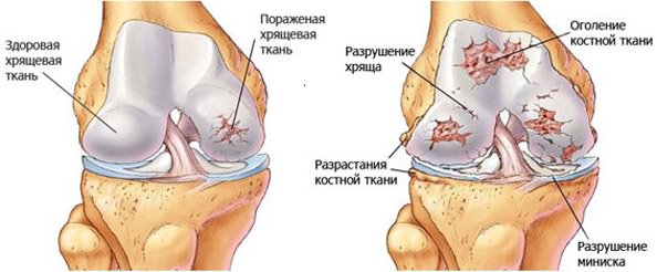 valmistamine jalgade liigeste anesteesia jaoks arthroosi seadistamise ravi