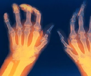 artriit parast vigastust kuna luud ja liigesed haiget