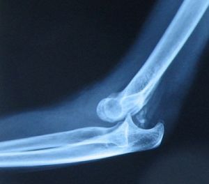 areng kuunarnuki liigese parast vigastusi arthrisa ravi