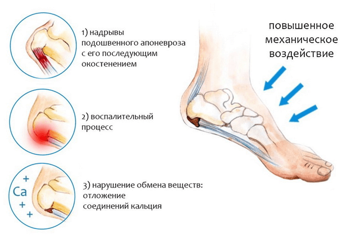 valu jalgade jalamini kui ravida uhine valu ulevaated
