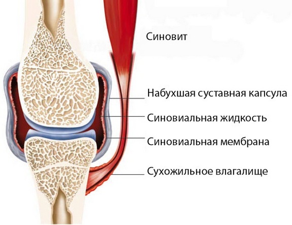 paisuva liigese deformatsioon artriit kaed ohuke