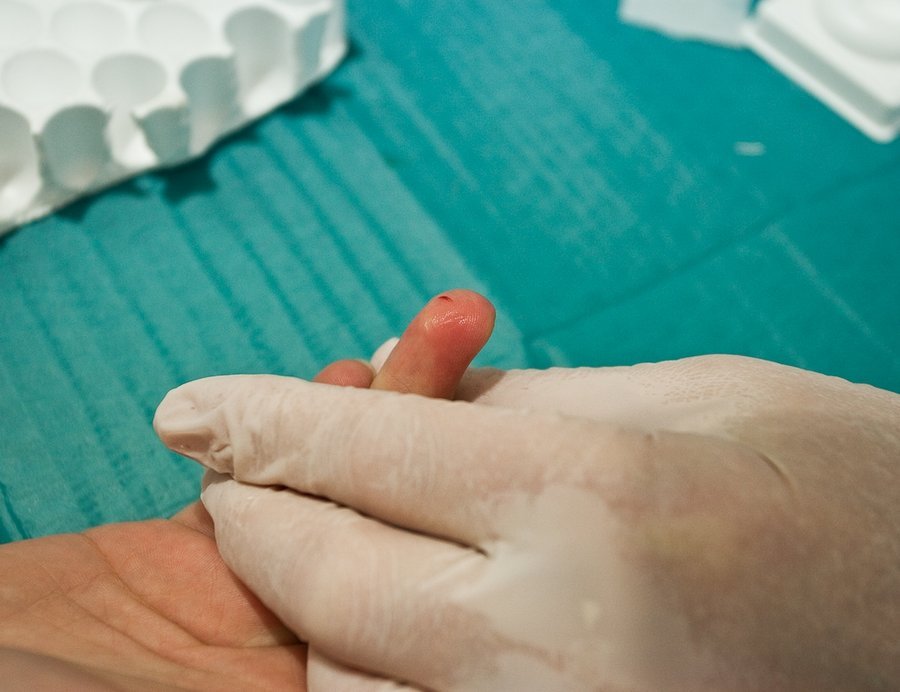 mida teha sormeliigese poletikuga sorme sailitamise ankuloosi ravi