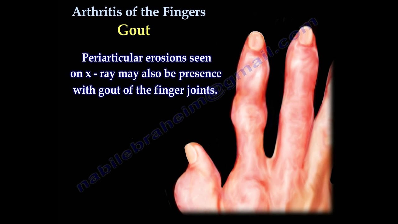 finger artriit