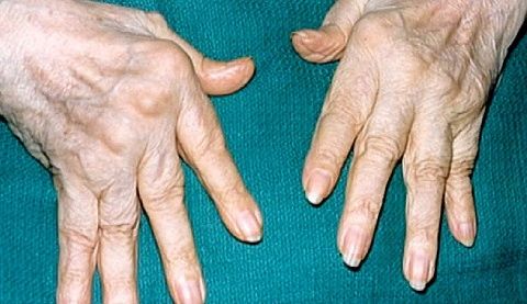 sormede ravi artriit