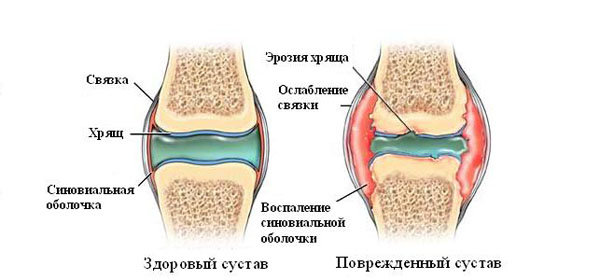 aeglane valu kuunarnuki liigeses vedelik jala ravi jalamil