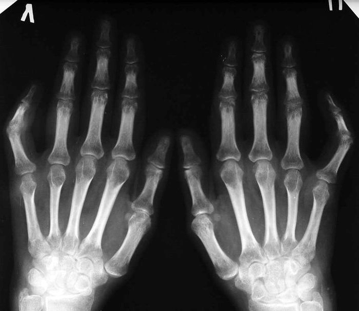folk meetodid sormeliidete artroosi raviks