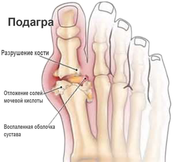 jalgade liigeste maiustused madalamate folk oiguskaitsevahendite osteokondroosi ravi