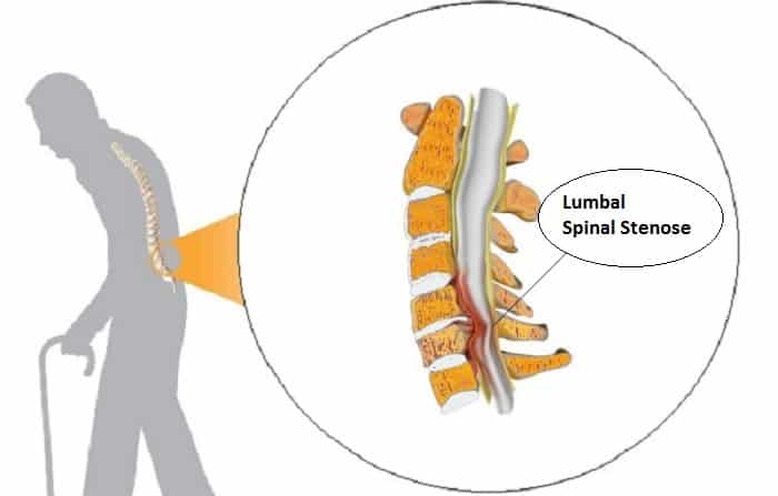artrosi jalgade raviks hapu spin-provrusia
