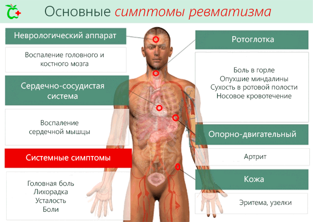 haiget ja klopsa sormede liigestele reumaatiline artriit