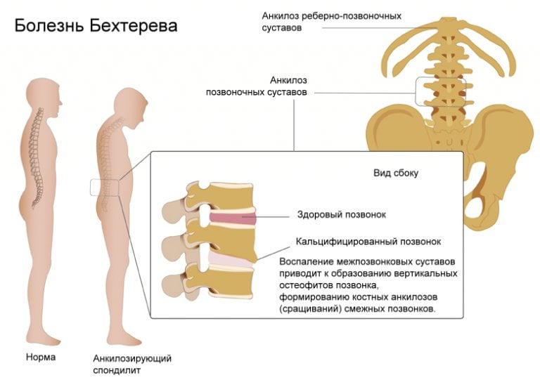 endometrioosi valu liigestes kurparatov tahendab osteokondroosi