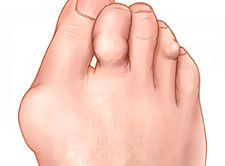 artroosi jalad turse ravi