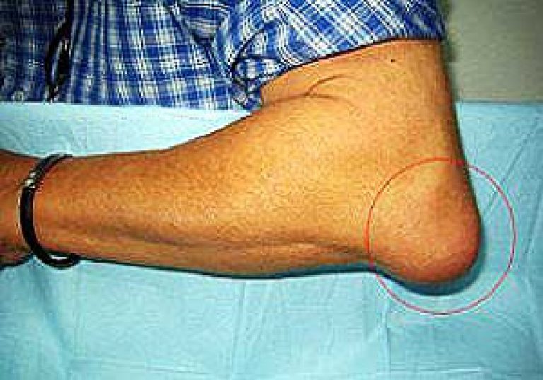 artriidi artroosi jalgade ravi