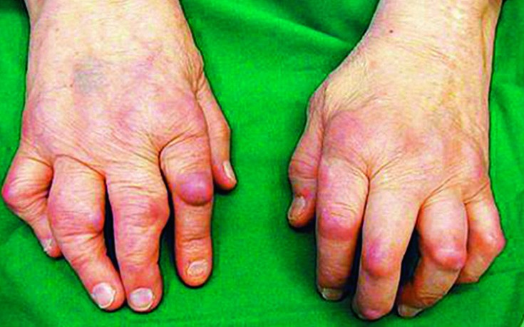 horsetail liigeste tootlemiseks artriidi podagra sormed