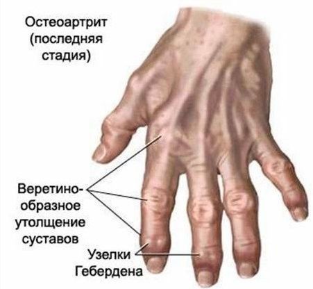 folk meetodid sormeliidete artroosi raviks