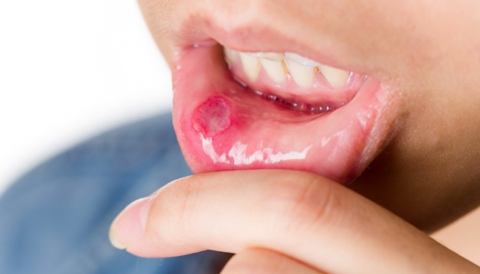 kuidas ravida suu valu