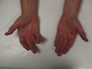 vasaku kae keskmise sorme artriit