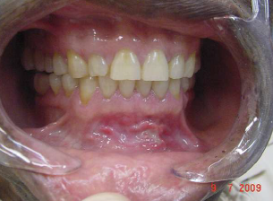 haavandid suus ja liigesevalu