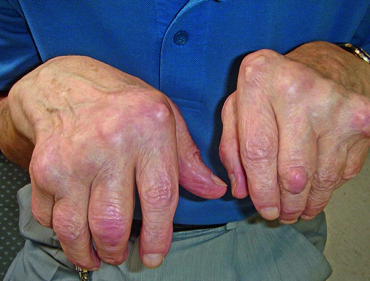 liigeste sormede artroos ravida