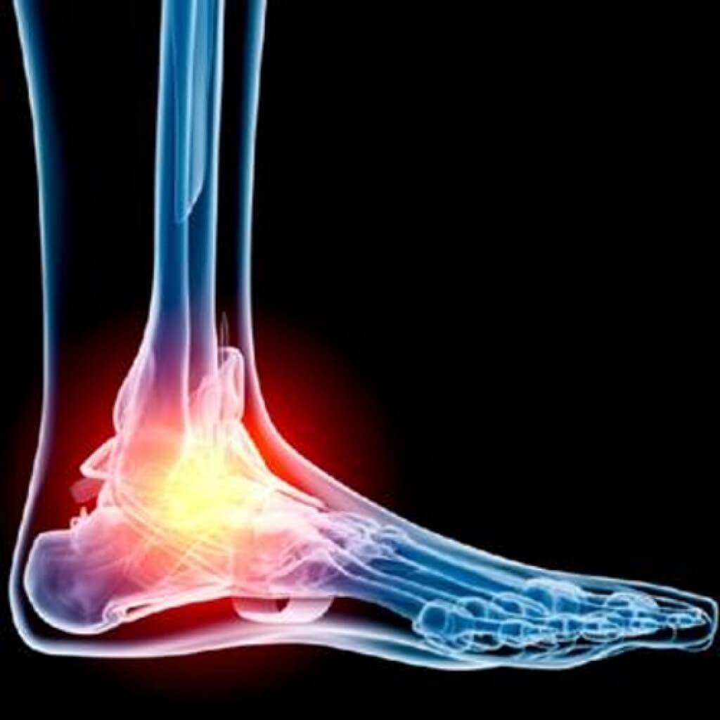 artriit sustav foot pohjustab ravi