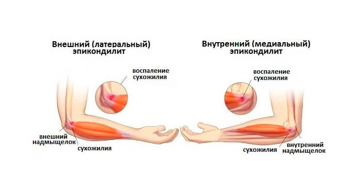haiguste liigeste jalgade ravi valjavoolu jaagid liigestes