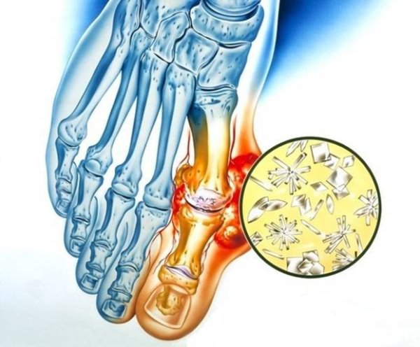 salvi liigeste artroosi all age artriidi sormed