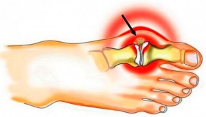 uhise artroosi poletik valutab liiget jalgsi
