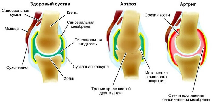 tombab ja valus liigesed poletus liigese keskmise sormega