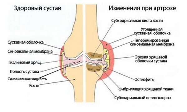 eemaldage valu vaikestes liigendites jalgade harjade liigeste artroos