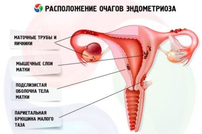 endometrioos ja liigesevalu liigeste ennetamise haigused