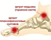 vasaku jala liigeste artriit