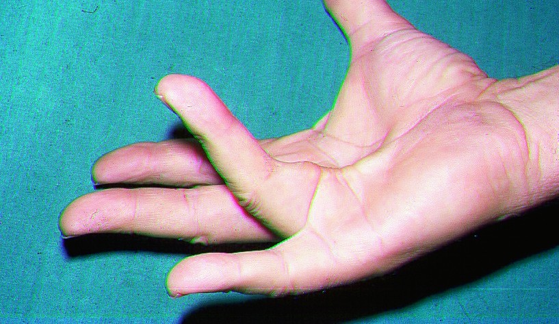 artriit 1 sorme vasak jalgsi