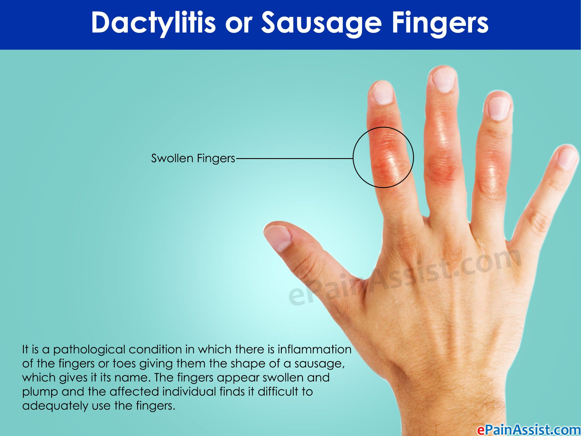 finger artriit