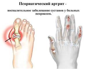 kuidas eemaldada turse sormest artriidi