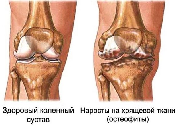 miks tekib liigeste artroos trauma liigesed jalad