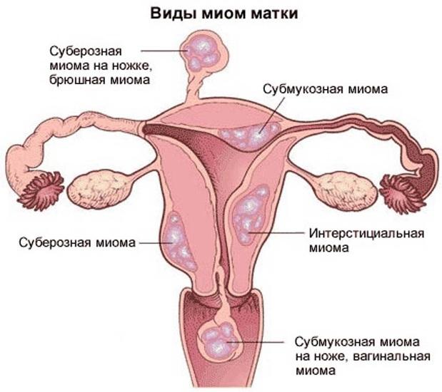 parast emaka ja munasarjade eemaldamist kahjustavad liigeseid