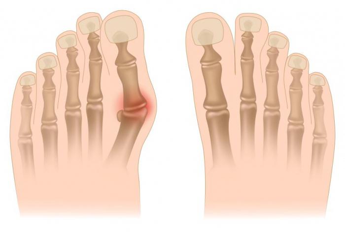 valutab liigese sormele parast vigastust kiire vahend osteokondroosi jaoks