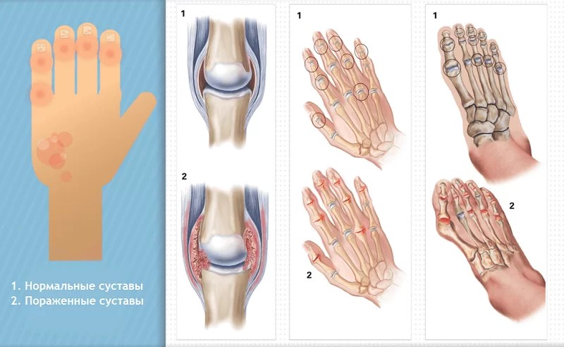reumatoidartriidi liigeste ulevaated fingering probleemid