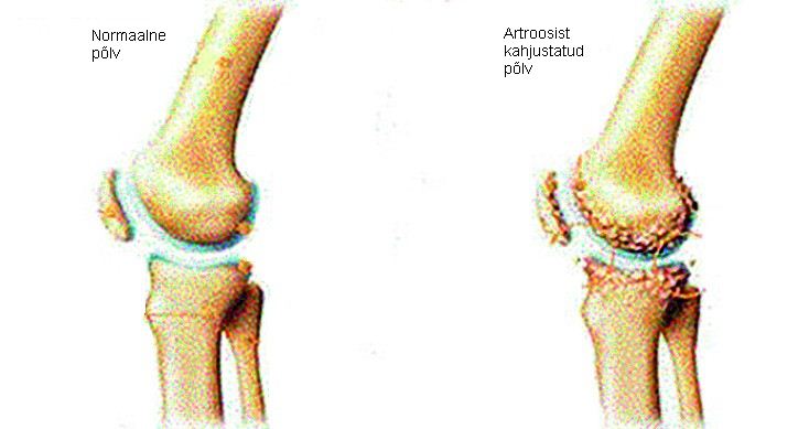 salv ola liigese artroosist