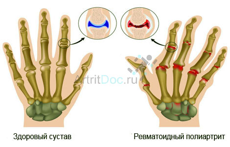 salv sorme artriidiga tugev valu uhise kaes