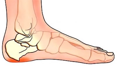 valu jala jalgsi hommikul artroosi voi poidla artriit