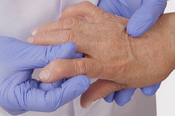 folk meditsiin sormede artriidi