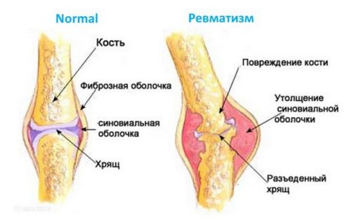 kuidas eemaldada valu sormeharja liigeses miks valu sormeotste liigestes