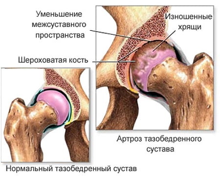 artriidi ravi artriidi liigese liigese probleem valu liigestes